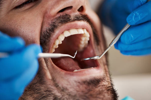 Best Emergency Tooth Extraction in Louisiana, MO